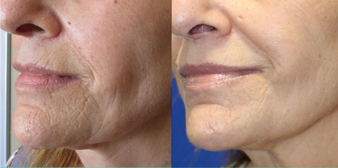 Before and After Pictures of Microneedling