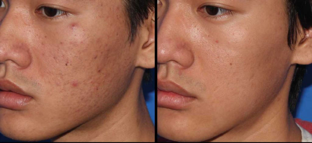 Micro Needling With PRP Before and After