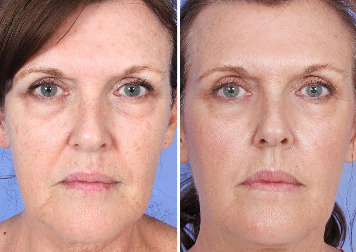 Microneedling With PRP Before and After