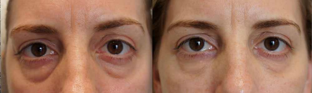 PRP Under Eyes Treatment Before and After