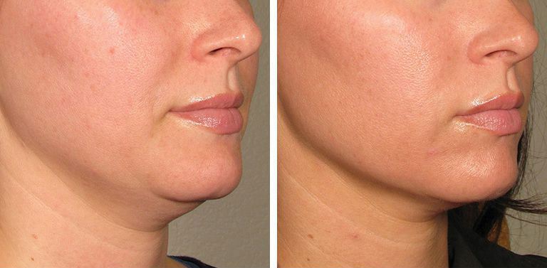 hgh for women before and after facial contours improved
