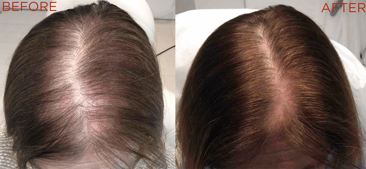 Platelet-Rich Plasma (PRP) for Hair Restoration