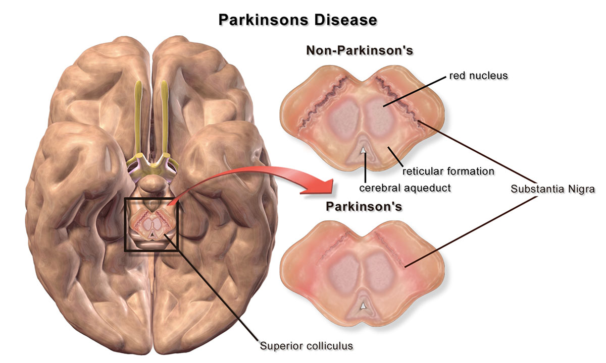 parkinsons disease diagram