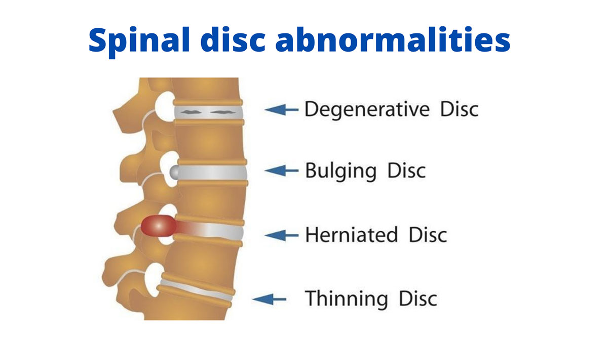 stem cell therapy for cervical degenerative disc disease